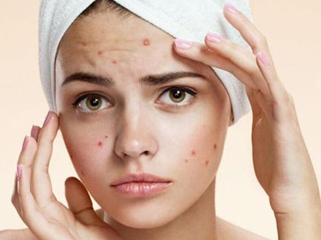 6 home remedies to get rid of those pesky acne scars naturally